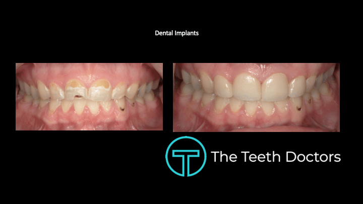 Dentist Fayetteville NC Before and After