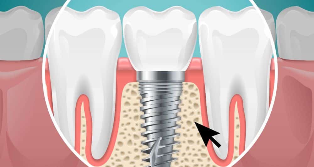 Extractions & Bone Grafts