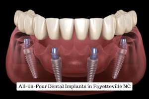 All-on-Four Dental Implants in Fayetteville NC
