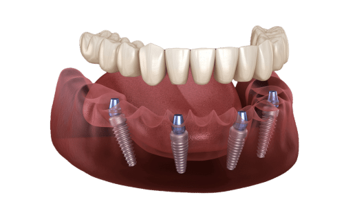 All on Four implant fixed Zirconia dentires fayetteville nc