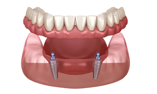 snapin overdenture 2 implants fayetteville nc