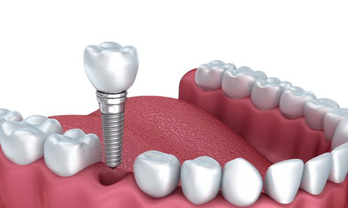 single dental implant fayetteville nc
