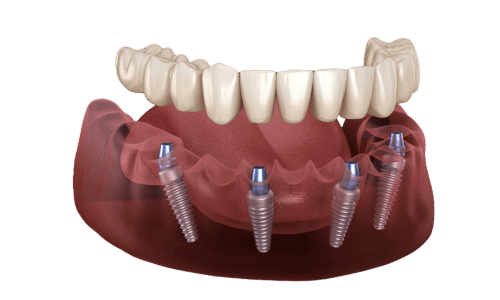 All on Four implant fixed Zirconia dentires fayetteville nc